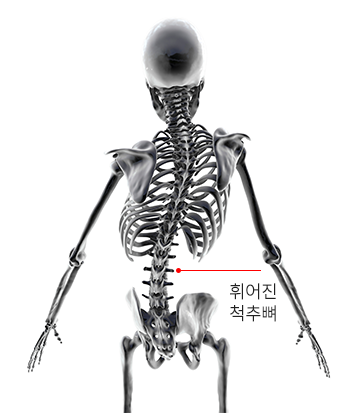 휘어진 척추뼈