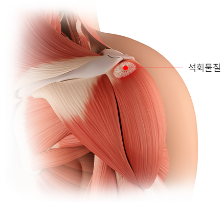 석회물질