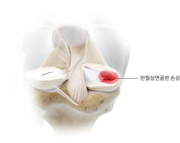 반월상연골판 손상