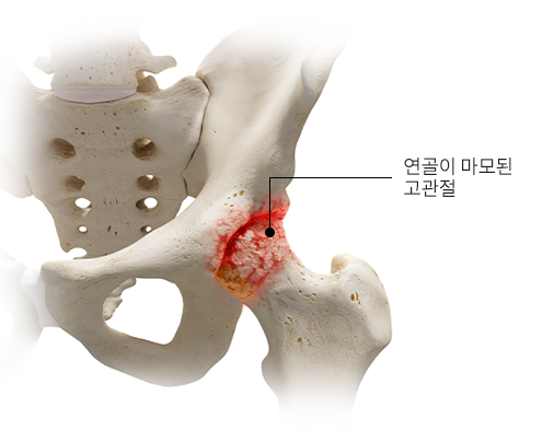 연골이 마모된 고관절