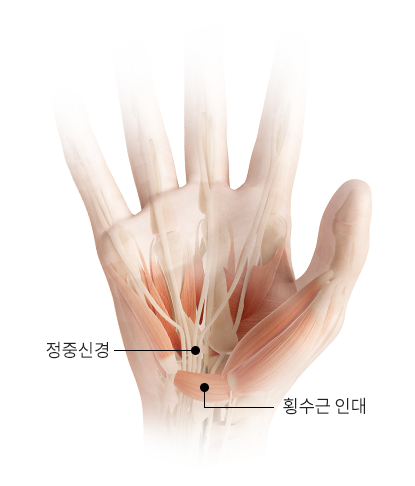 정중신경, 횡수근 인대